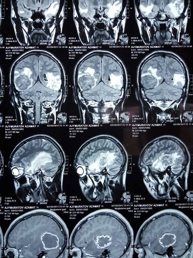 Brain 23. Альвеококкоз головного мозга мрт. Альвеококкоз головного мозга фото.
