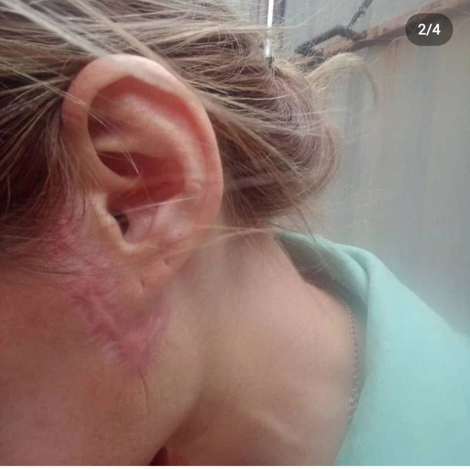 Женщина получила страшные шрамы после подтяжки лица на Ошском рынке. Ведется проверка.