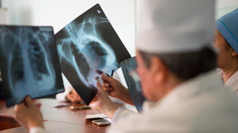 ФОМС: Туберкулез остается одним из наиболее серьезных заболеваний в Кыргызстане