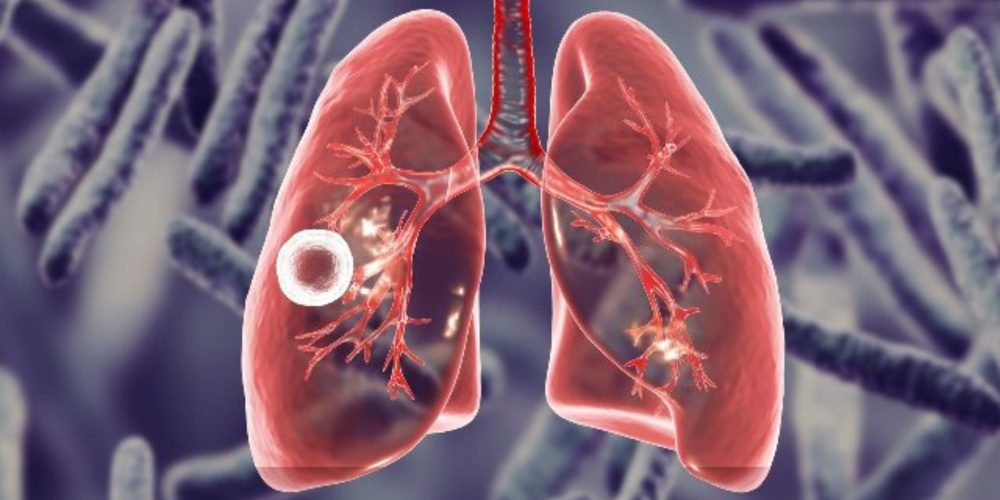 Ежегодно 200 человек умирают от туберкулеза в Кыргызстане