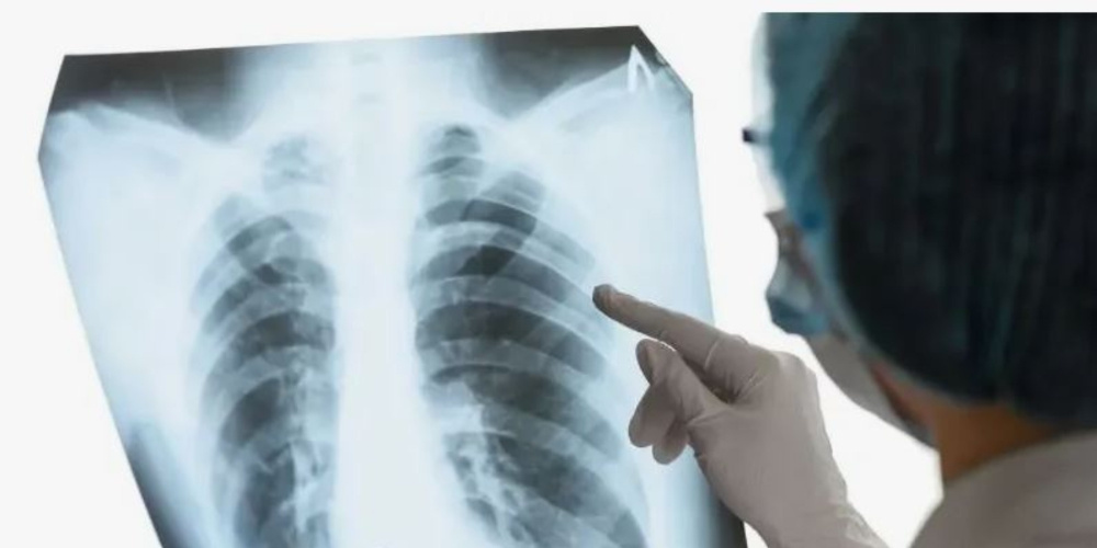Скрытая угроза. Каждый пятый случай туберкулеза остается незамеченным