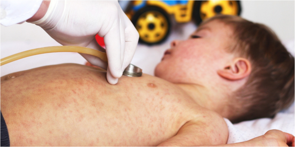 Почему краснуха исчезает, а корь возвращается. Данные по Кыргызстану